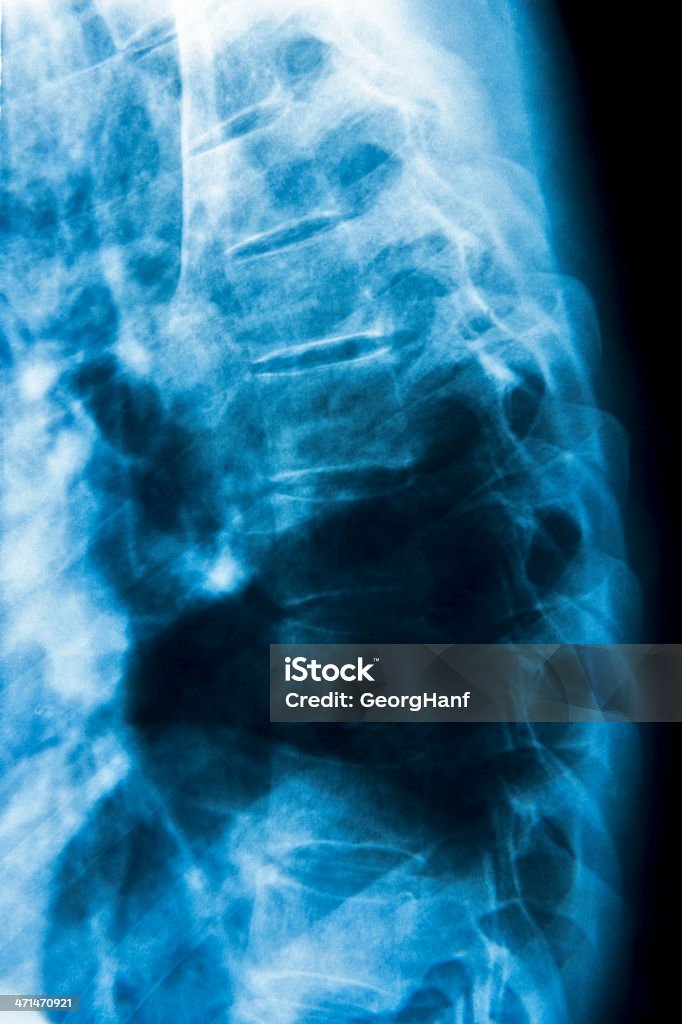 Human spine X-ray image of the human spine. Side view. Adult Stock Photo