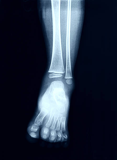 imagem de raios x do pé. - bending human foot ankle x ray image - fotografias e filmes do acervo