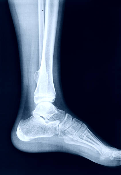 imagerie par rayons x des pieds - bending human foot ankle x ray image photos et images de collection