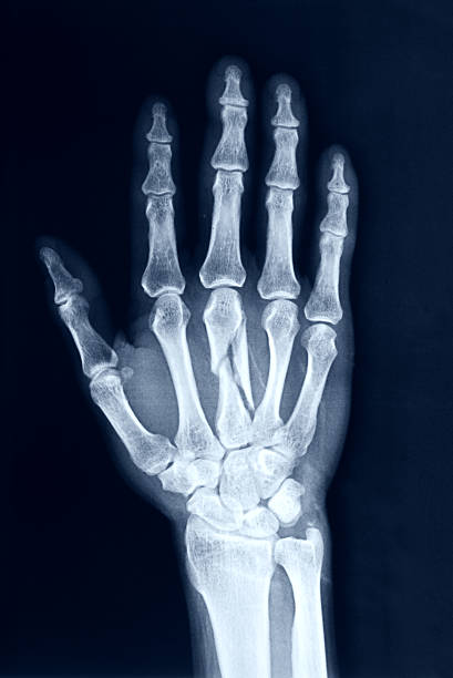 image au rayon x mains - x ray x ray image human hand anatomy photos et images de collection