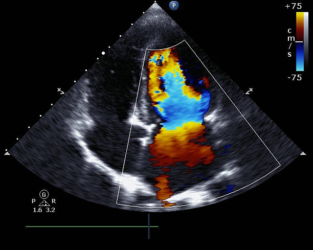 Doppler echocardiogram Transthoracic two-dimensional color Doppler echocardiography aorta photos stock pictures, royalty-free photos & images