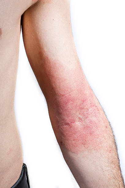 istock Skin dermatitis rash on inside of male's elbow 471532116