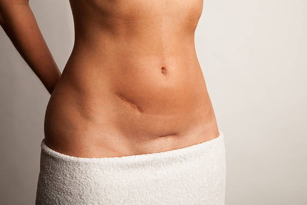 Stomach of a woman with scars Stomach of a woman with scars and a towel flower stigma stock pictures, royalty-free photos & images