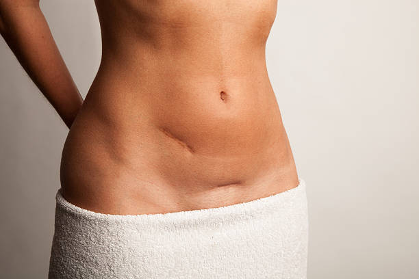 Stomach of a woman with scars Stomach of a woman with scars and a towel scar stock pictures, royalty-free photos & images
