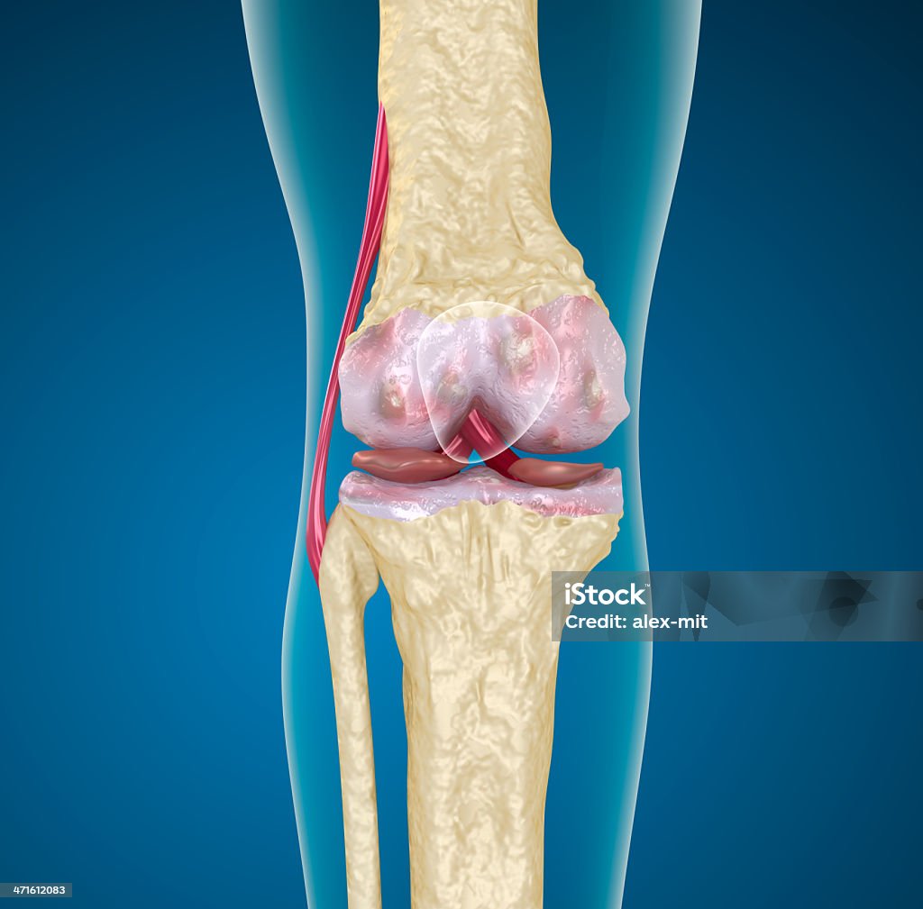 L'ostéoporose de l'articulation du genou. - Photo de Anatomie libre de droits