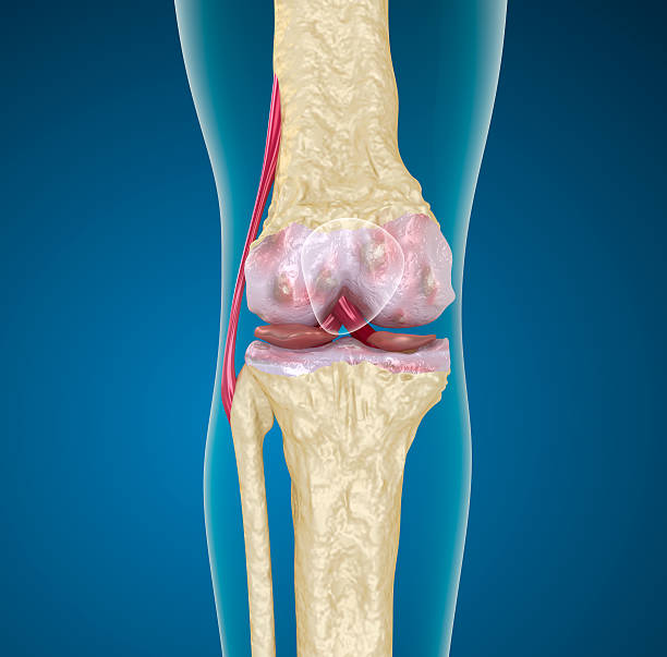 istock Osteoporosis of the knee joint. 471612083