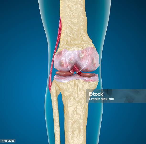 Остеопороз Из Коленного Сустава — стоковые фотографии и другие картинки Анатомия - Анатомия, Биология, Болезнь