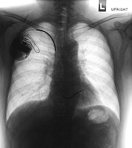 istock chest with the pacemaker on x-ray film 471620782