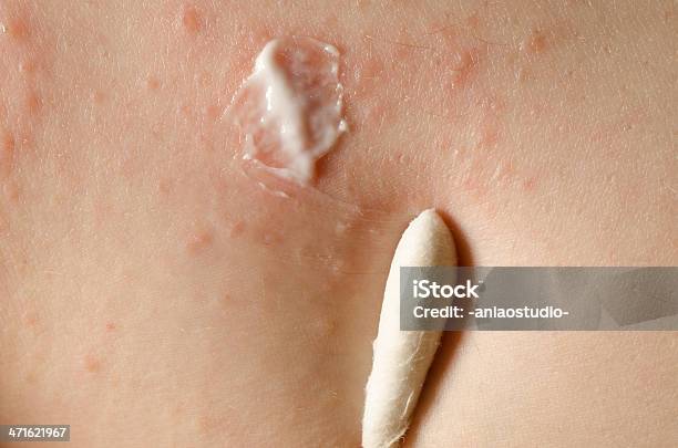 Aplicação Tópica Do Medicamento Na Pele Do Eczema - Fotografias de stock e mais imagens de Alergia - Alergia, Antialérgico, Condição