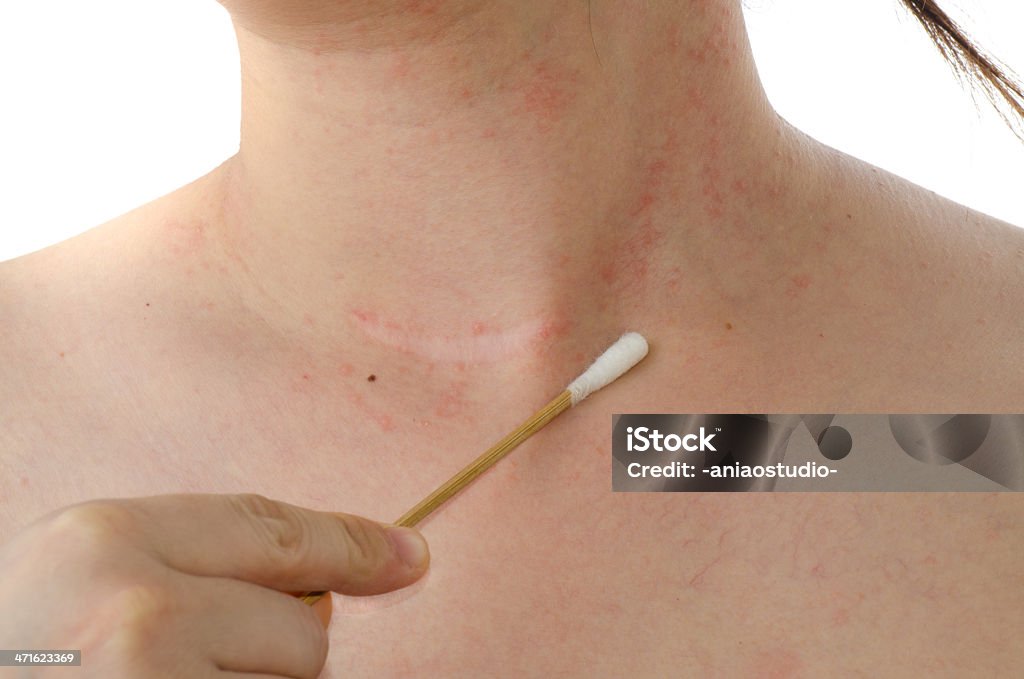 eczema pele de mulher no pescoço - Foto de stock de Psoríase royalty-free