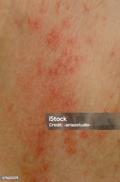 Eczema Haut Stockfoto und mehr Bilder von Allergie - Allergie, Dermatitis, Dermatologie