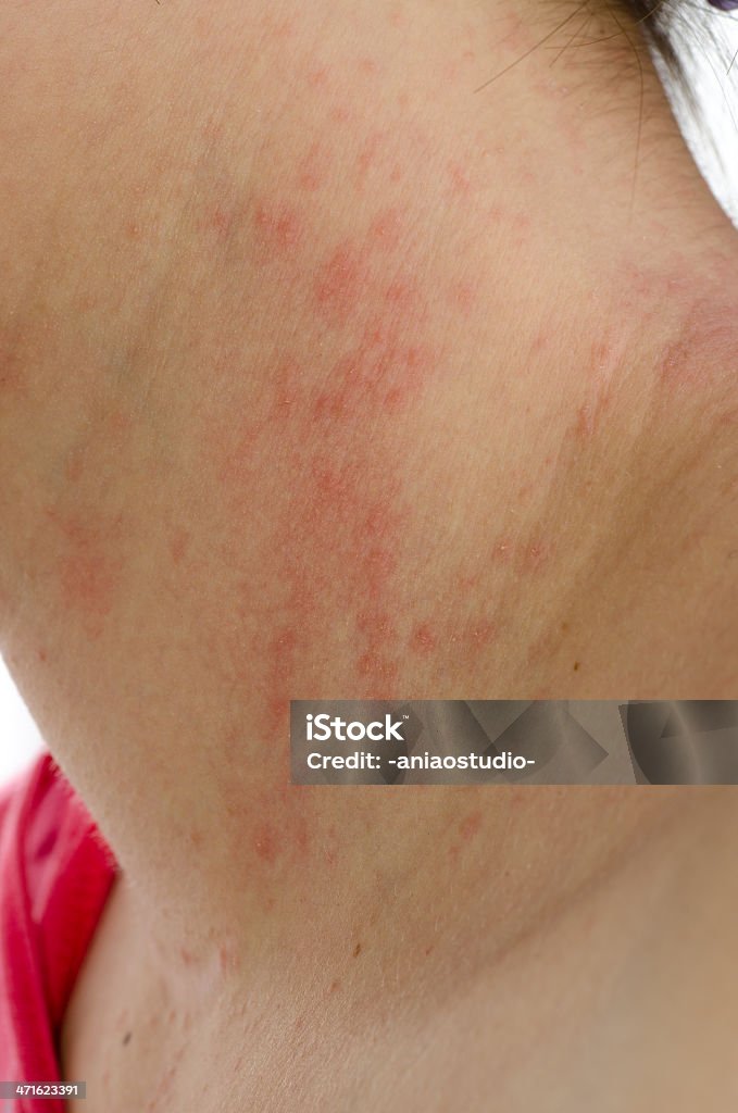 eczema お肌に首 - 乾癬のロイヤリティフリーストックフォト