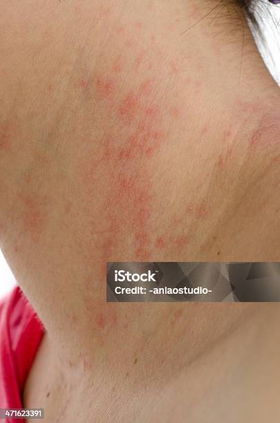 Eczema お肌に首 - 乾癬のストックフォトや画像を多数ご用意 - 乾癬, クローズアップ, 掻く