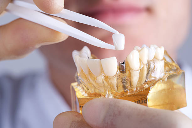 doctor showing dental implant stock photo