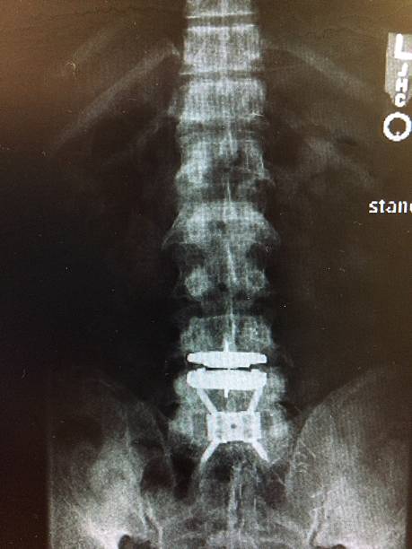 요추 결합 및 artifical 디스크 교체 ap 보기 - orthopedic equipment osteoporosis x ray human spine 뉴스 사진 이미지