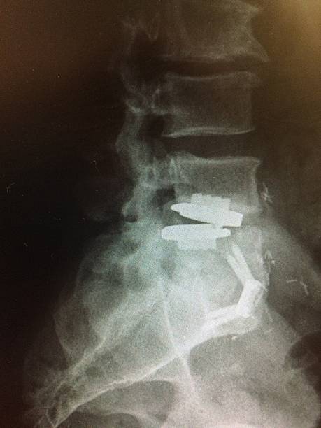 안되었음 요추 인공 디스크 교체 l 4-5 기포수준기 레터럴 보기 - orthopedic equipment osteoporosis x ray human spine 뉴스 사진 이미지