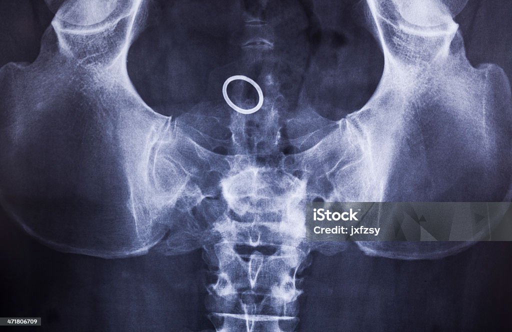 Cavità pelvico x ray - Foto stock royalty-free di Zona inguinale