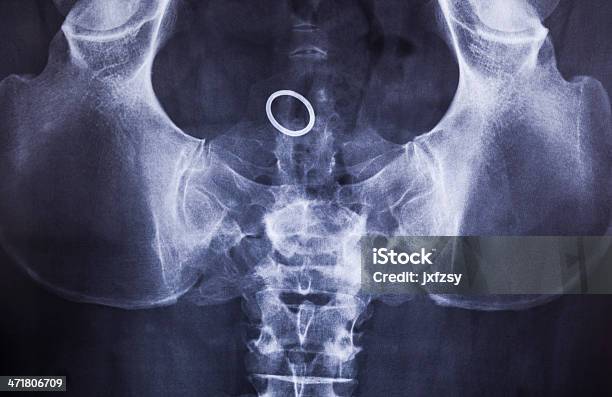 Cavità Pelvico X Ray - Fotografie stock e altre immagini di Zona inguinale - Zona inguinale, Anatomia umana, Bianco