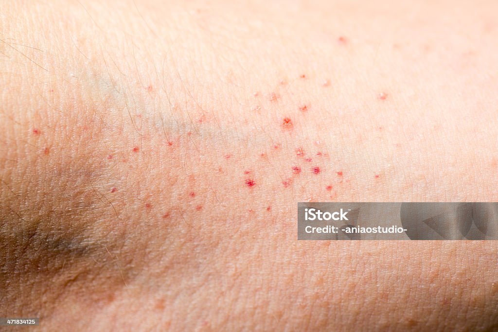 L'eczéma peau à la main - Photo de Allergie libre de droits