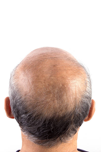 istock hair loss bald man 471867973