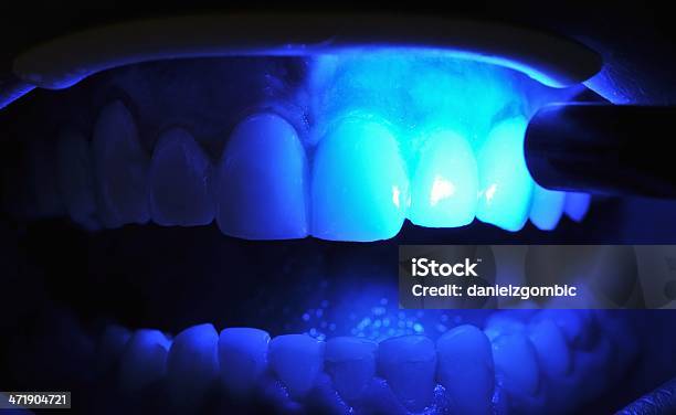 Dentystycznych Leczenia - zdjęcia stockowe i więcej obrazów Badanie lekarskie - Badanie lekarskie, Ból zęba, Dziąsła