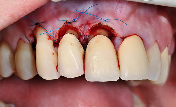 Gingivoplasty procedure Gingivoplasty procedure . Selective focus. gingivoplasty stock pictures, royalty-free photos & images