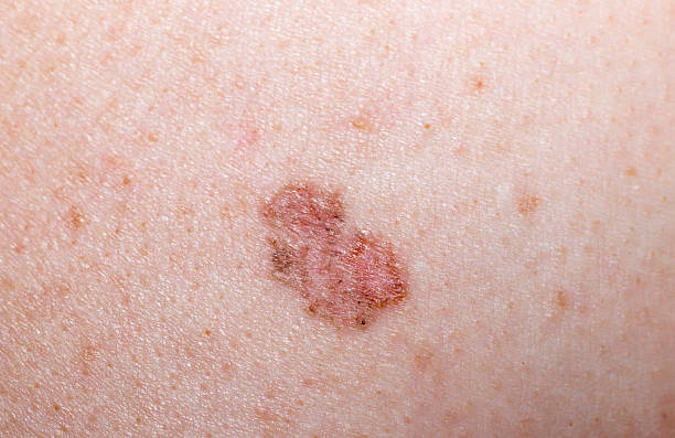 istock Skin marking of darkened circle 471915124