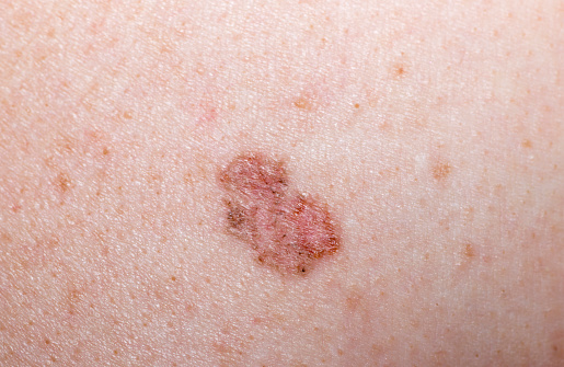 Pigmented superficial type basal cell carcinoma (skin cancer).  A centimeter ruler is shown next to the lesion.
