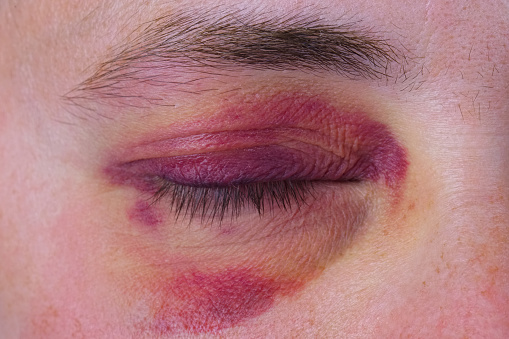 Human eye with a large purple bruise