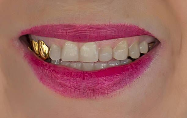 Зубы с напылением как выглядит Зубы с напылением как выглядит