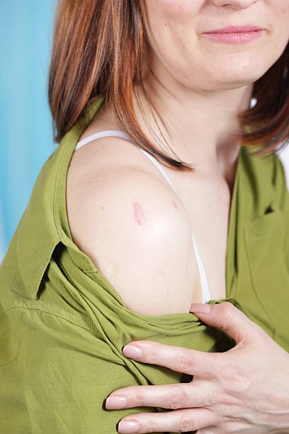 Ring Worm infection, Dermatophytosis on skin. Ringworm infection or Tinea on skin. Mycosis infection on the human skin. It is caused by a fungus