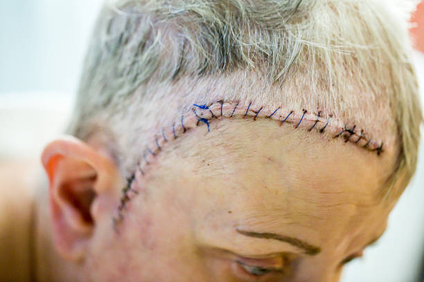 Stitches And Incison After Brain Surgery Stock Photo - Download Image Now - Aggression, Hospital, Adult - iStock Stitches And Incison After Brain Surgery Stock Photo - Download Image Now - Aggression, Hospital, Adult - iStock