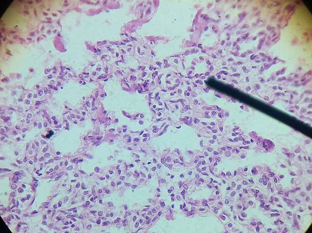 membrana ialina malattia (rds)-malattia polmonare - blood cell cell human cell animal cell foto e immagini stock