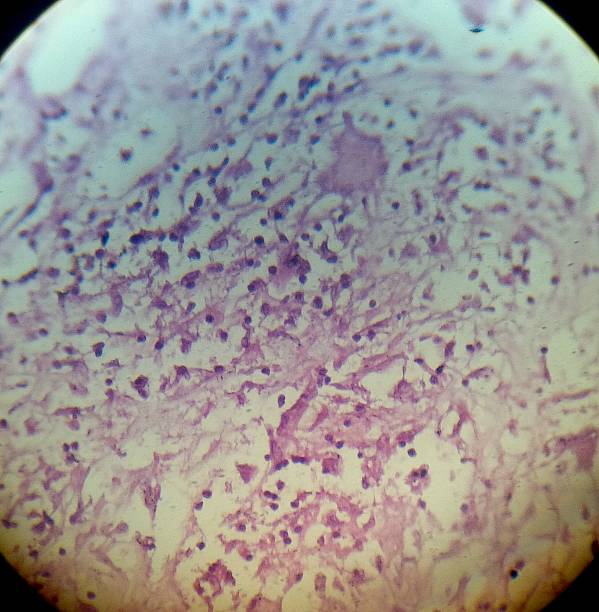 Giant Cell, Pulmonary TB - Lung Disease