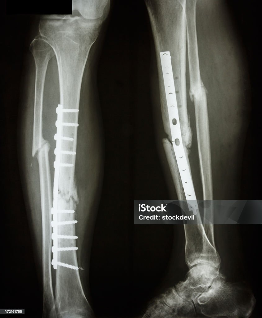 fracture shaft of tibia and fibula film leg AP/lateral : show fracture shaft of tibia and fibular (leg's bone). patient was operated and insert plate and screw for fix leg's bone Bone Fracture Stock Photo