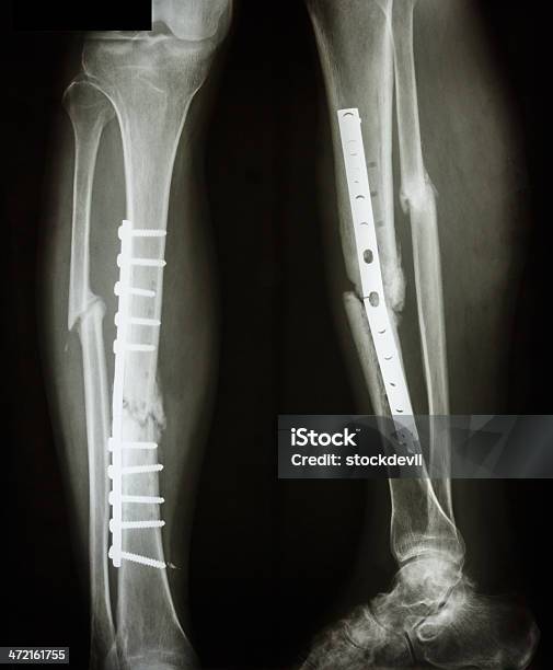Fracture Shaft Of Tibia And Fibula Stock Photo - Download Image Now - Bone Fracture, Plate, Anatomy