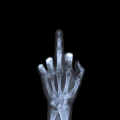 Middle finger radiography