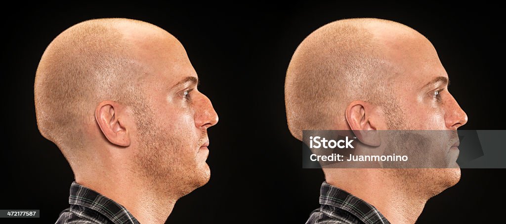 Before and after Plastic Surgery profile pictures of a caucasian mid adult man before and after plastic surgery on his nose. This picture could be very useful for plastic surgery promotional brochures and marketing Nose Job Stock Photo