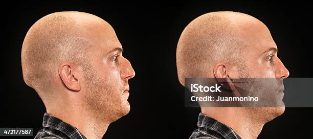 Before And After Plastic Surgery Stock Photo - Download Image Now - Nose Job, Men, Nose