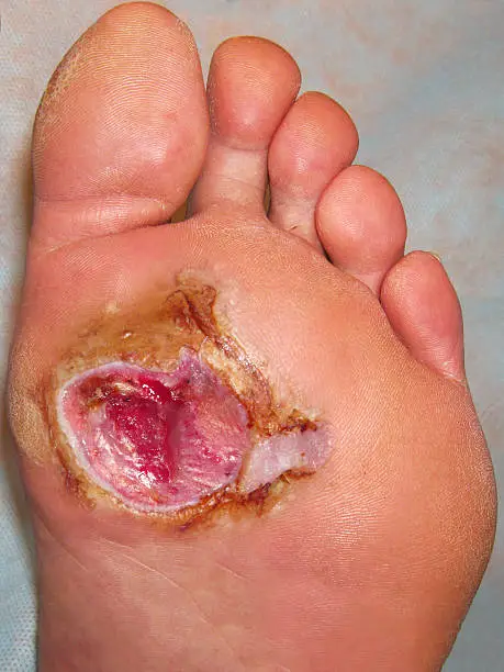 Photo of Diabetic Foot