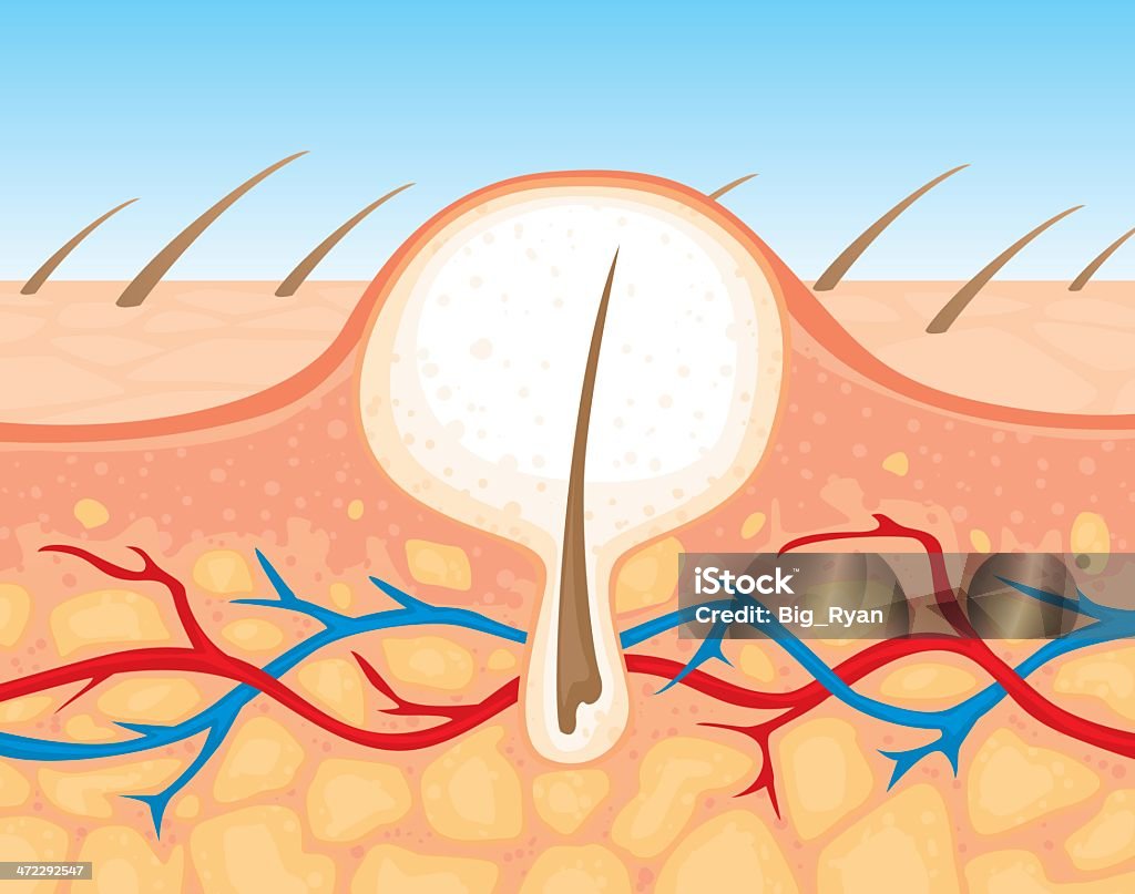 Zit Object Zit Cross Section Stock Illustration - Download Image Now - Bacterium ...