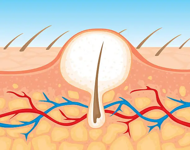 Vector illustration of zit cross section