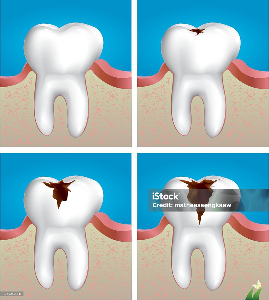 Zahn Verfall - Lizenzfrei Zahnbein Vektorgrafik