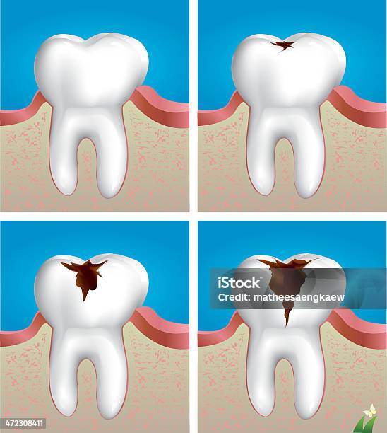 Carie - Immagini vettoriali stock e altre immagini di Dentina - Dentina, Anatomia umana, Antigienico