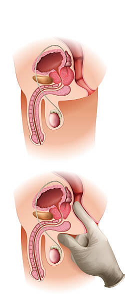 ilustraciones, imágenes clip art, dibujos animados e iconos de stock de cáncer de próstata - prostate exam