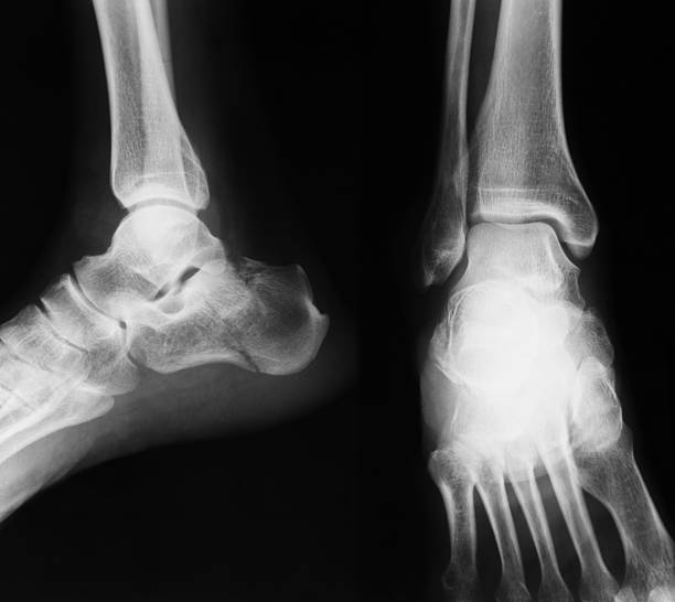 x-ray image der knöchel, ap und seitlicher blick - bending human foot ankle x ray image stock-fotos und bilder