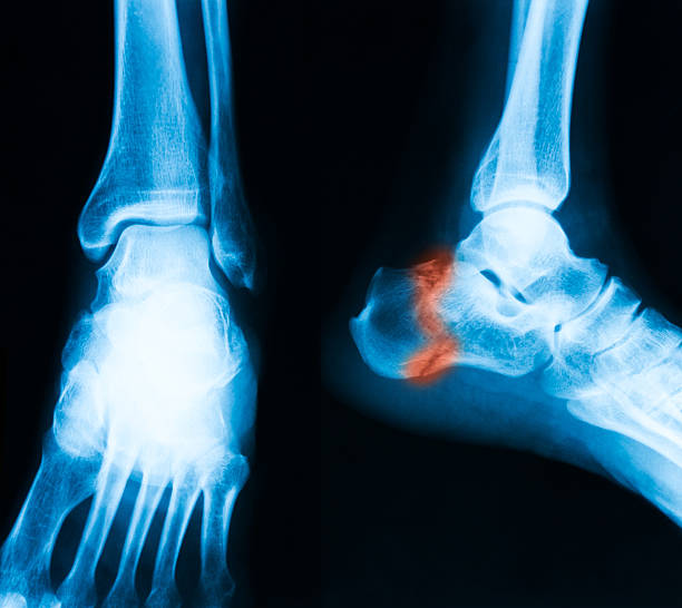 x-ray image der knöchel, ap und seitlicher blick - bending human foot ankle x ray image stock-fotos und bilder