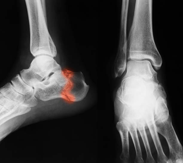 imagem de raios x de tornozelo, ap e vista lateral. - bending human foot ankle x ray image - fotografias e filmes do acervo