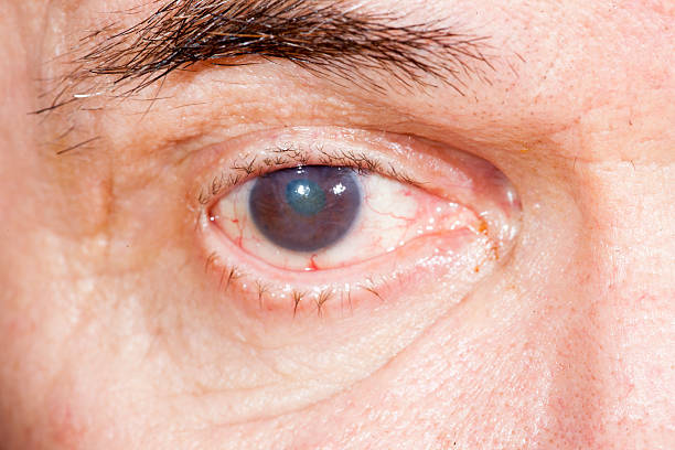 Eye disease infecting a brown eye