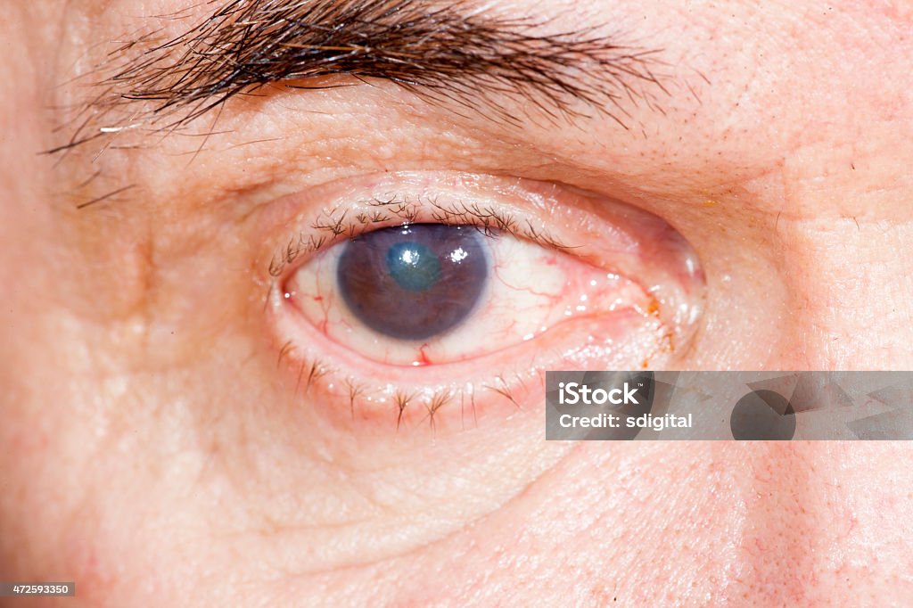 Eye disease infecting a brown eye close up of the senile cataract during eye examination, Cataract Stock Photo